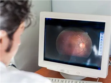 نموذج مرض الرئيسيات غير البشرية من AMD