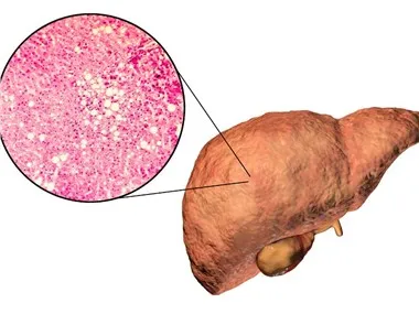 نموذج NHP لالتهاب الكبد الدهني غير الكحولي (NASH).