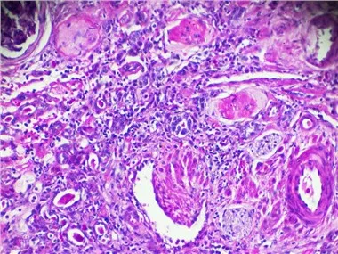 إصابة نقص التروية الكلوية بنموذج الرئيسيات غير البشرية (انتقال AKI إلى CKD)