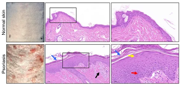 Psoriasis Model of monkey Psoriasis Model of monkey