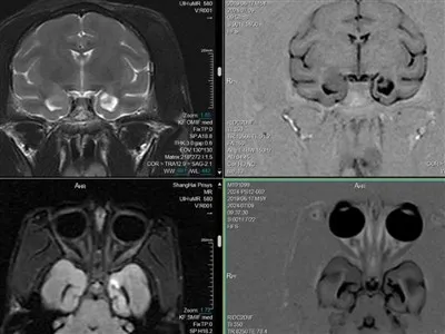 نموذج الصرع