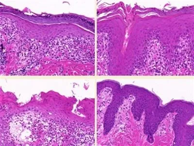 نموذج استجابة الأجسام المضادة المعتمدة على الخلايا التائية (TDAR).